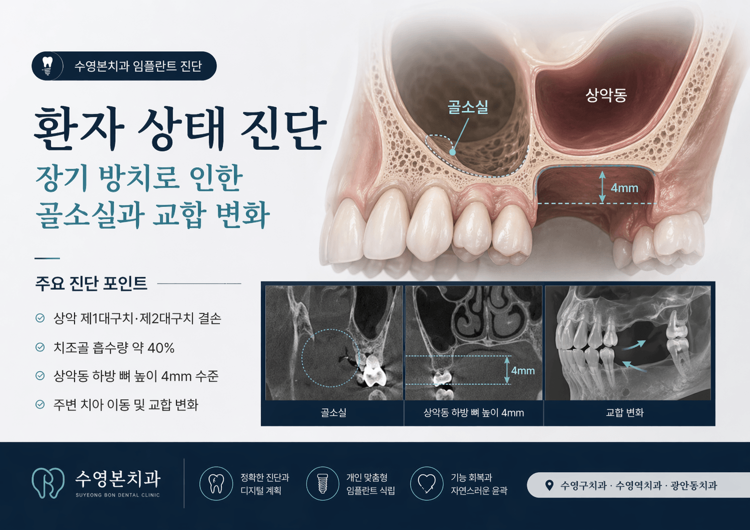 수영본치과 골소실 진단 상악동 하방 뼈 높이 4mm 분석