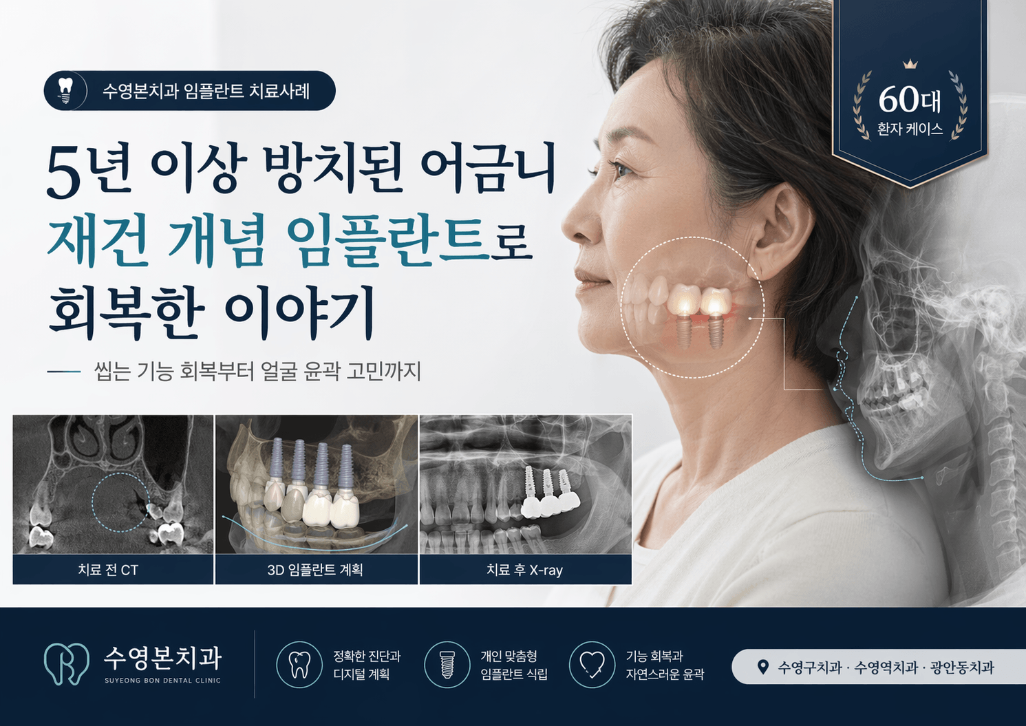 수영구치과 임플란트 재수술 60대 환자 뼈이식 치료 사례