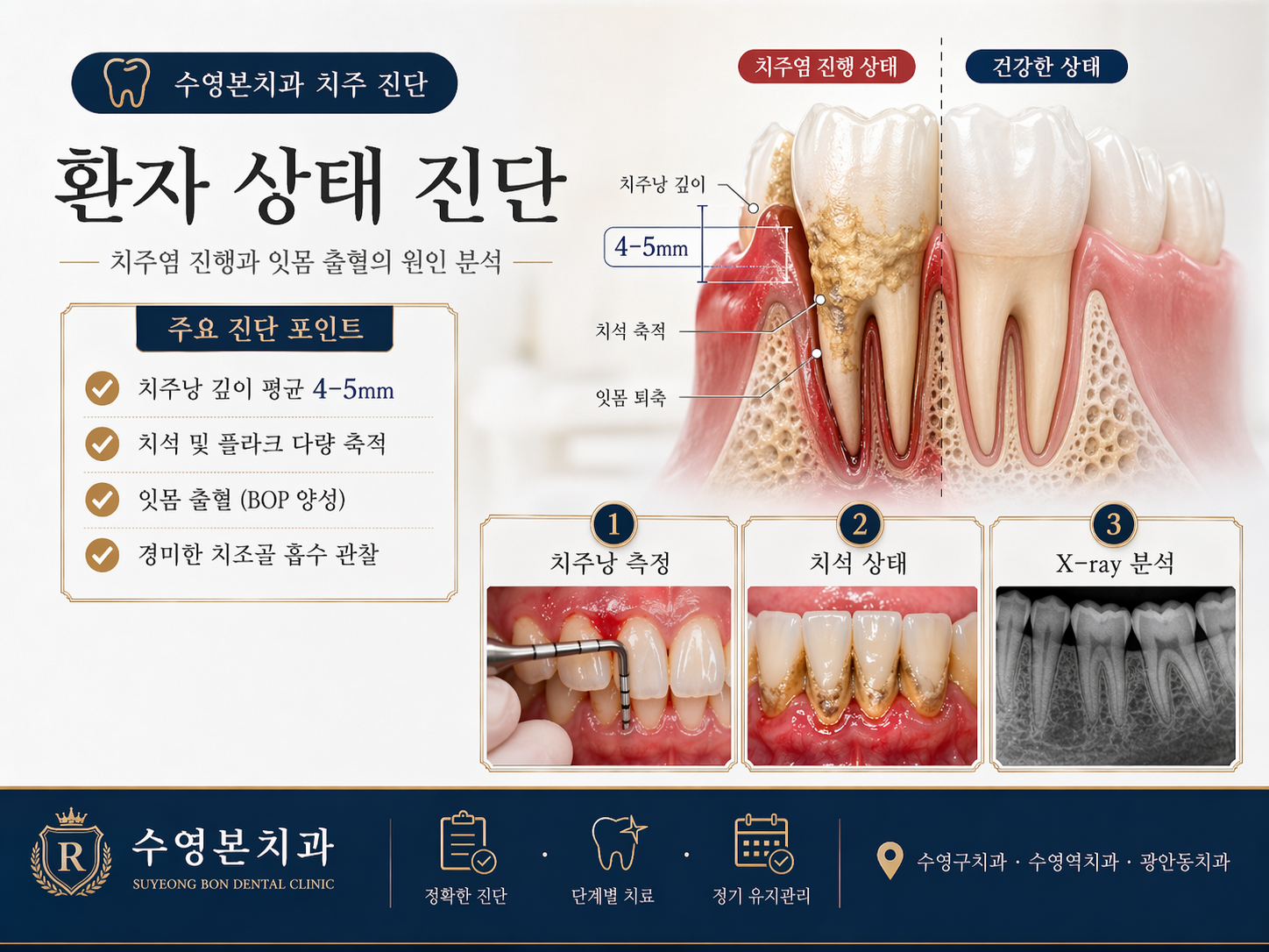 수영본치과 치주염 진단 치주낭 4-5mm 치석 축적 분석