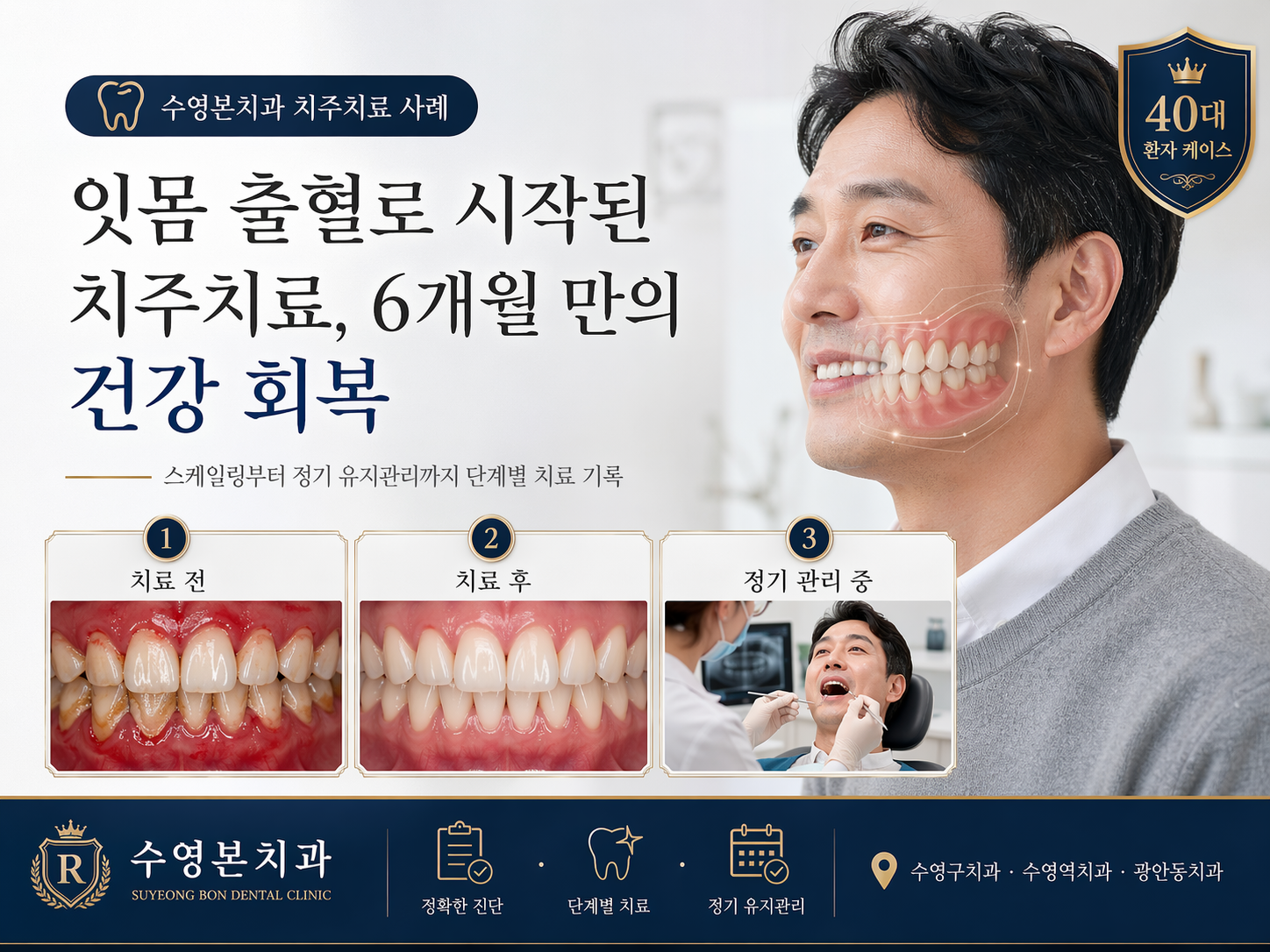 수영역치과 치주치료 스케일링 40대 환자 잇몸 건강 회복 사례