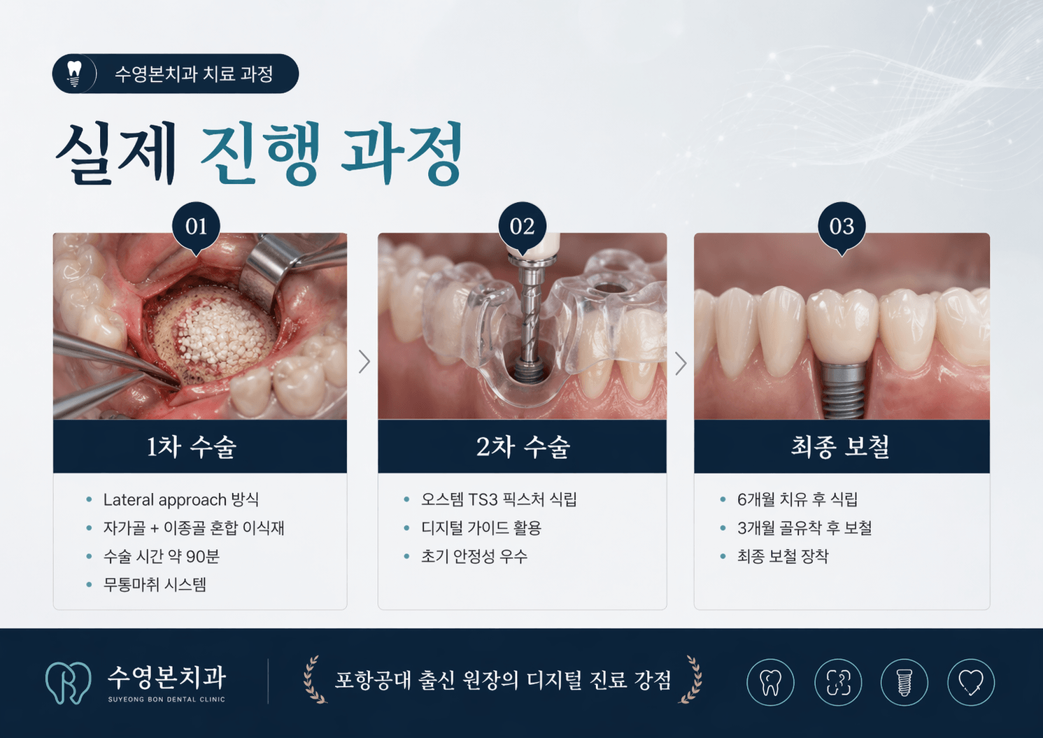 수영본치과 임플란트 수술 과정 Lateral approach 디지털 가이드 오스템 TS3