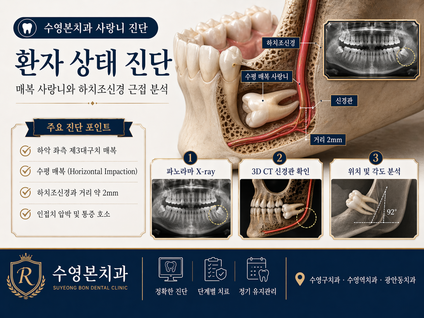 수영본치과 매복 사랑니 3D CT 진단 하치조신경 근접 분석