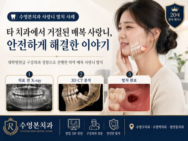 수영구치과 매복 사랑니 발치, 타 치과 거절 케이스 대학병원급 처치 사례