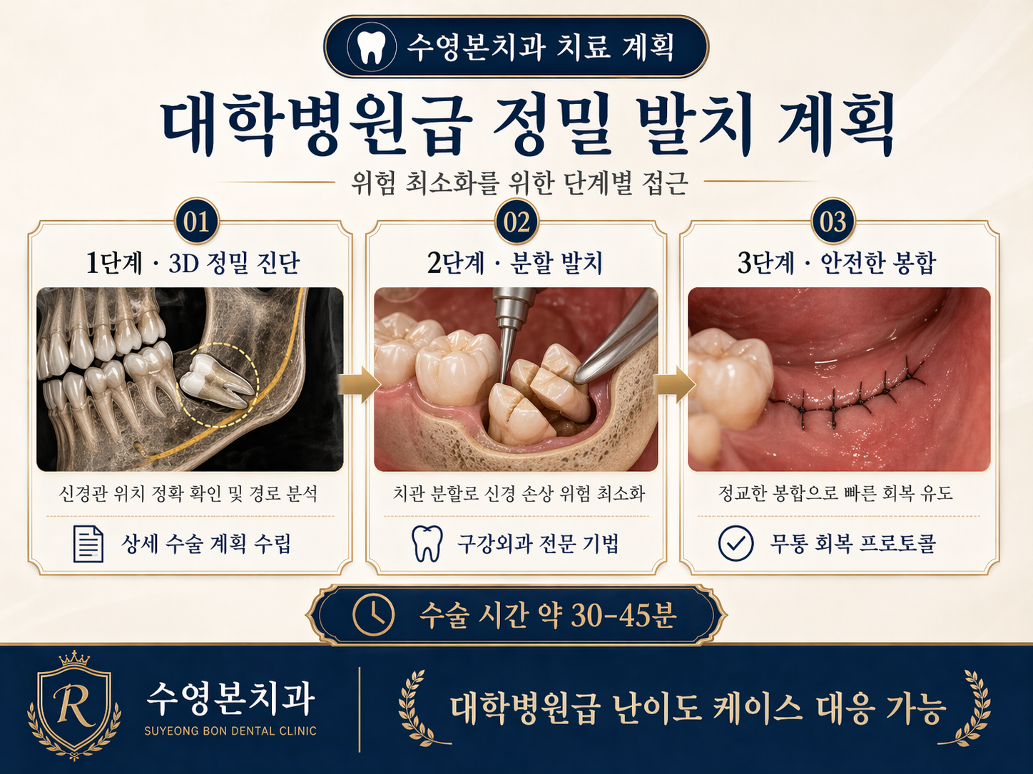 수영구치과 사랑니 발치 3단계 계획 3D 진단 분할 발치 봉합