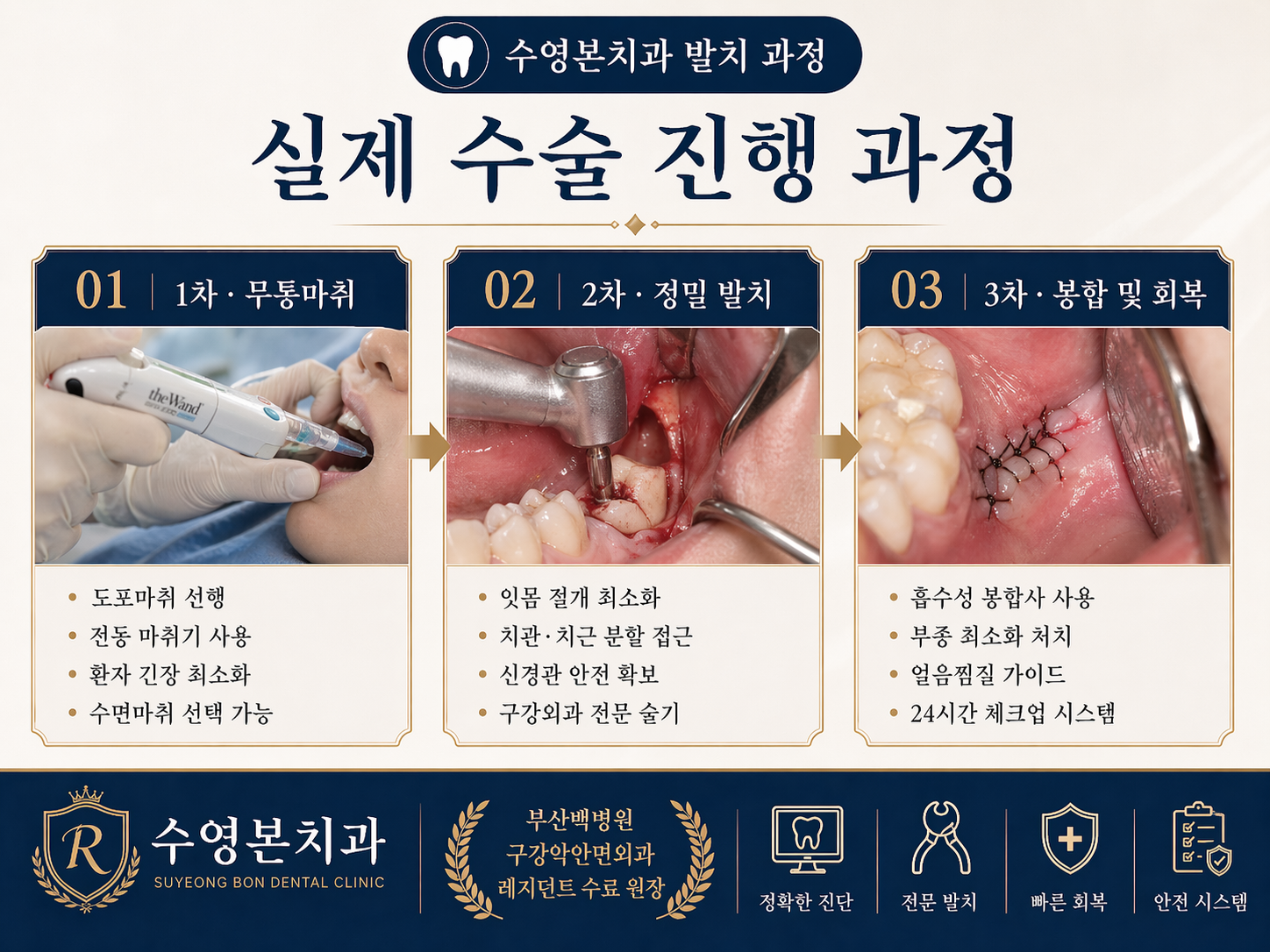 수영본치과 매복 사랑니 수술 과정 무통마취 정밀 발치 봉합